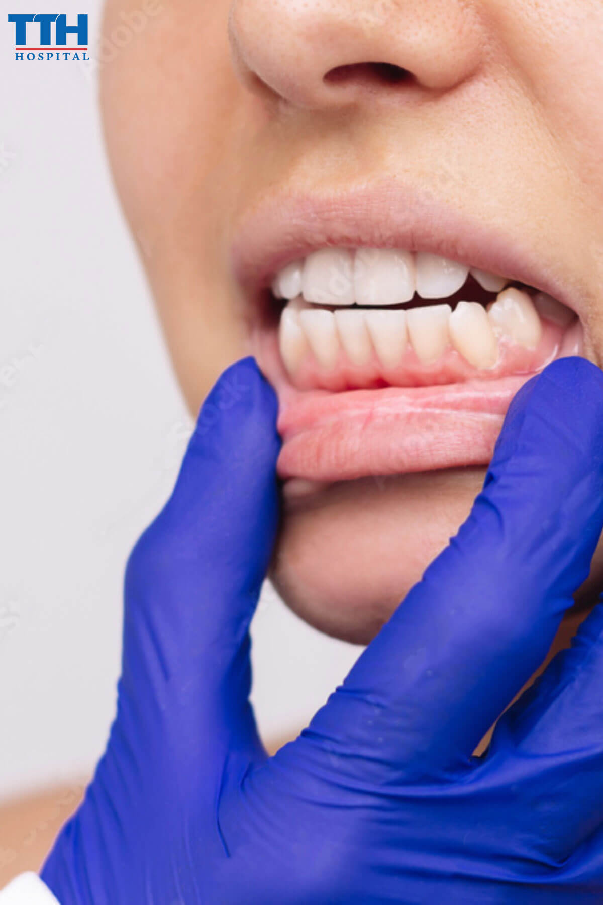 Bị móm tại Vinh nghệ an là gì?