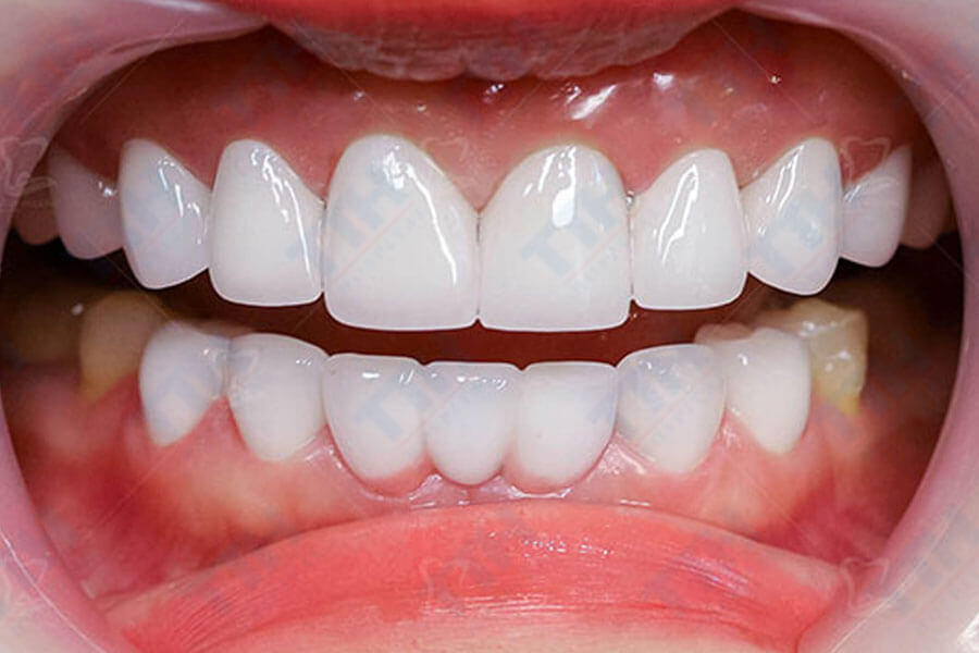 Bleach Zirconia không chỉ mang lại vẻ đẹp thẩm mỹ