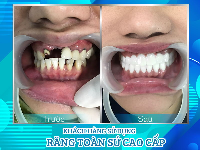 Bọc răng sứ thực hiện như thế nào?