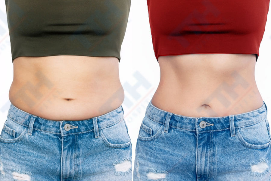 Body Jet cho phép bác sĩ thực hiện hút mỡ với độ chính xác cao