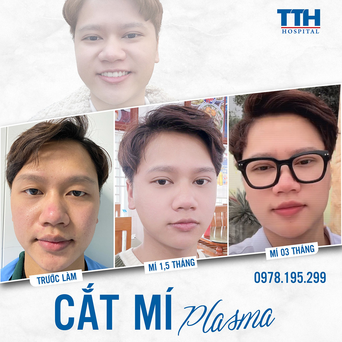Thẩm mỹ mắt toàn diện thay đổi dung mạo
