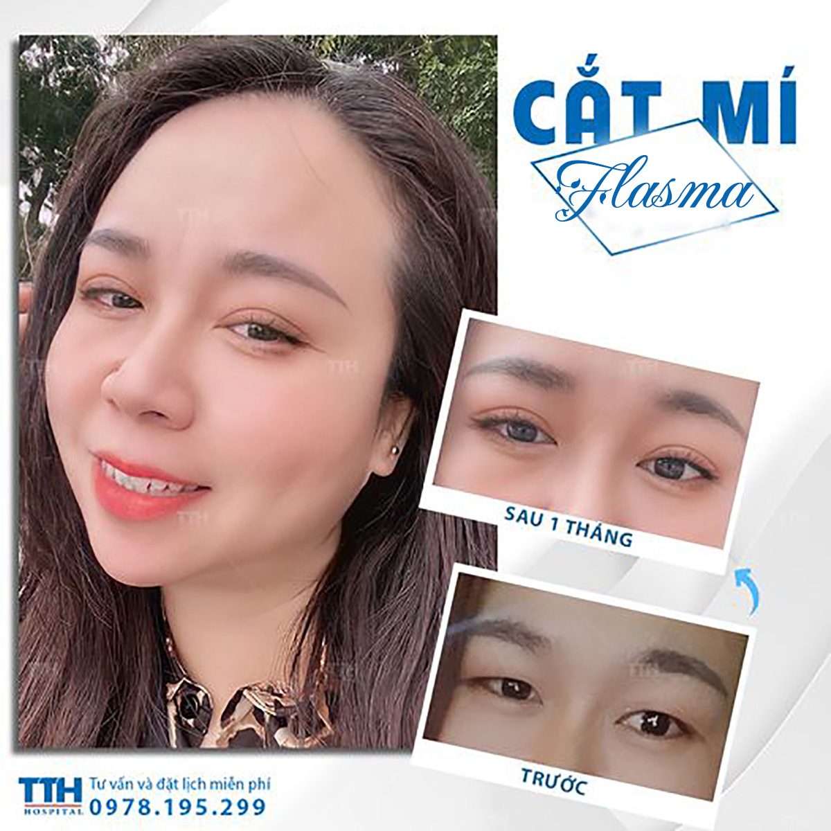 Thẩm mỹ mắt làm khuôn mặt trở nên hài hòa và đẹp hơn
