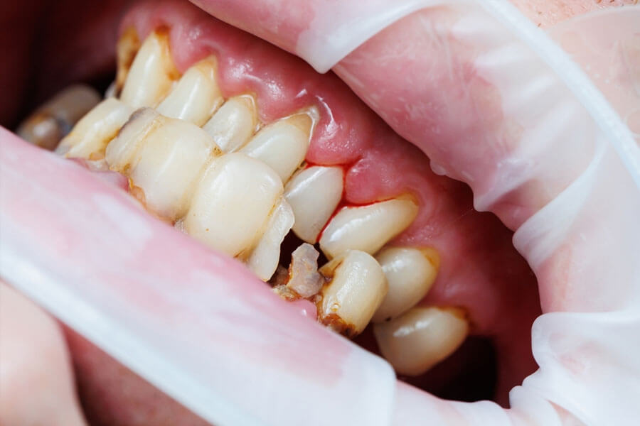 Các yếu tố ảnh hưởng đến thời gian tồn tại của răng chết tủy
