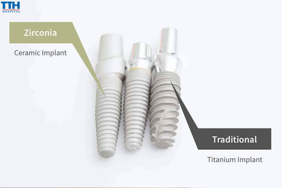 Các giải pháp thay thế cho implant titan