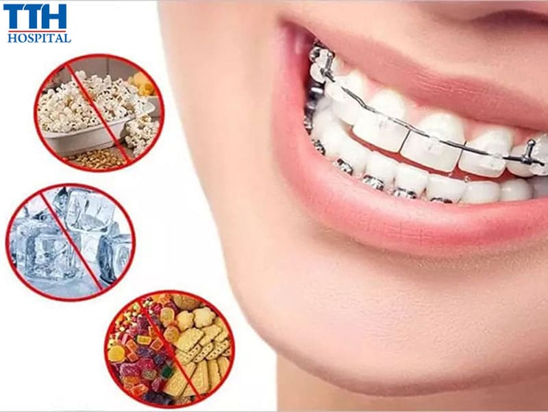 Các lưu ý khi niềng răng mà bạn cần biết