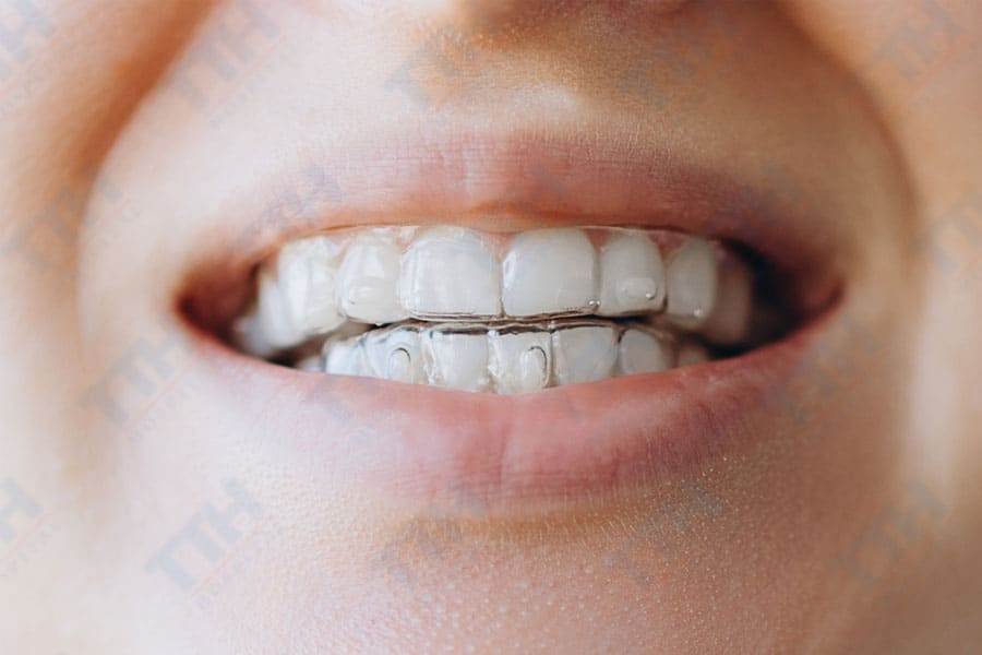 Các phương pháp điều trị răng móm