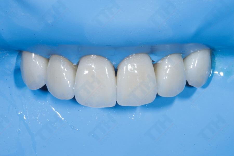 Các Yếu Tố Ảnh Hưởng đến Giá Răng Sứ Zirconia