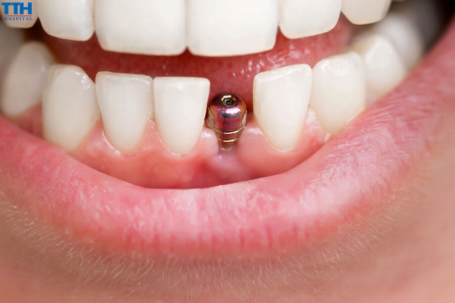 Tổng quan về trồng răng implant