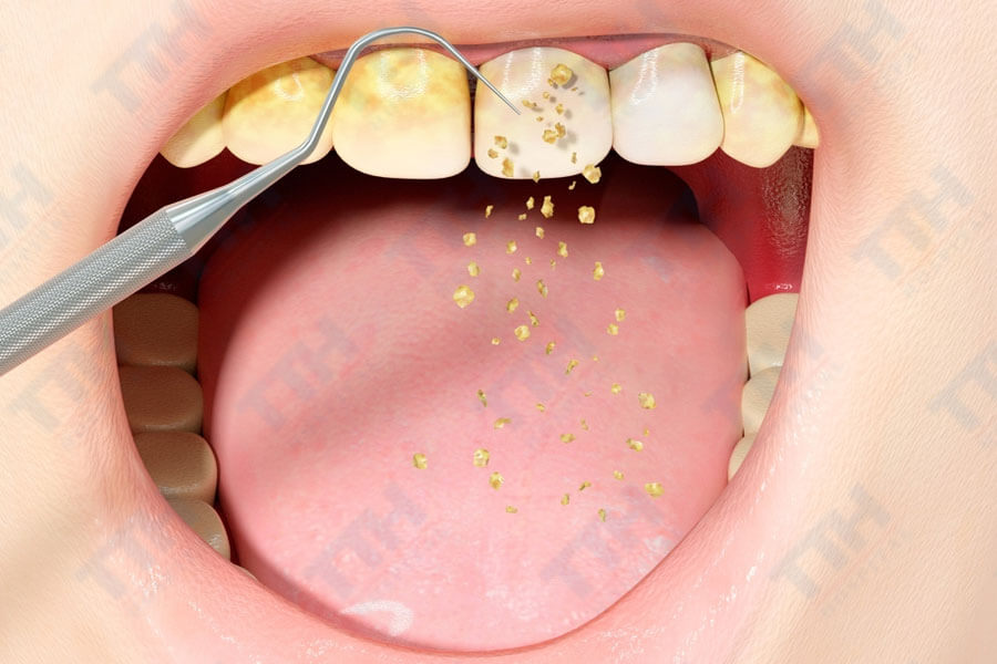 Cách bảo vệ răng trong và sau khi lấy cao răng
