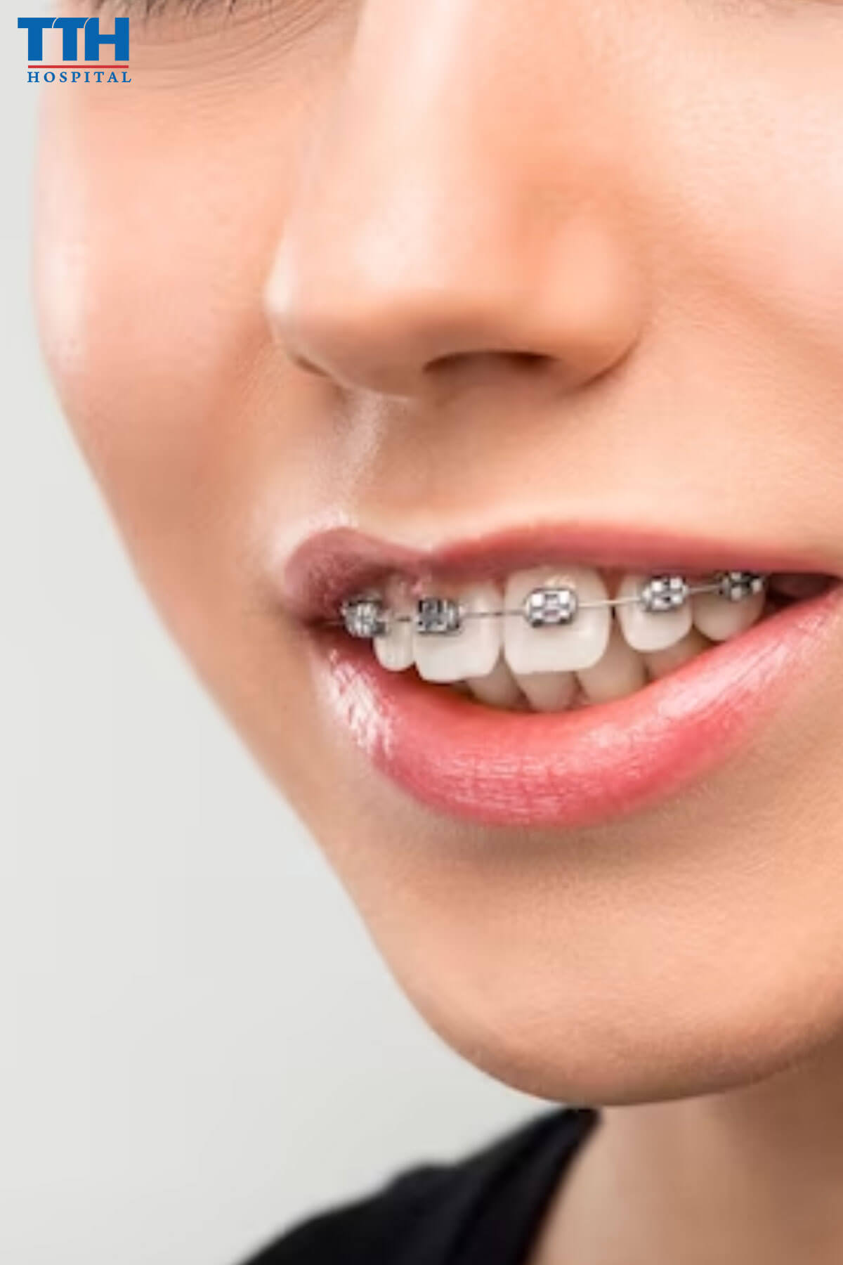 Cách điều trị răng hô tại Vinh nghệ an