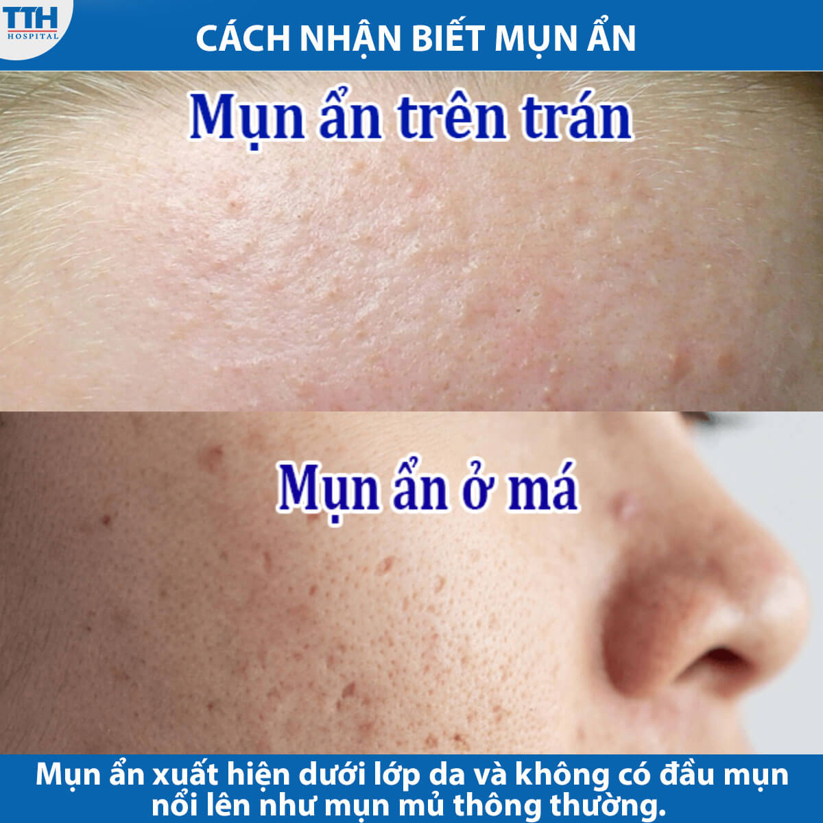 Cách nhận biết mụn ẩn