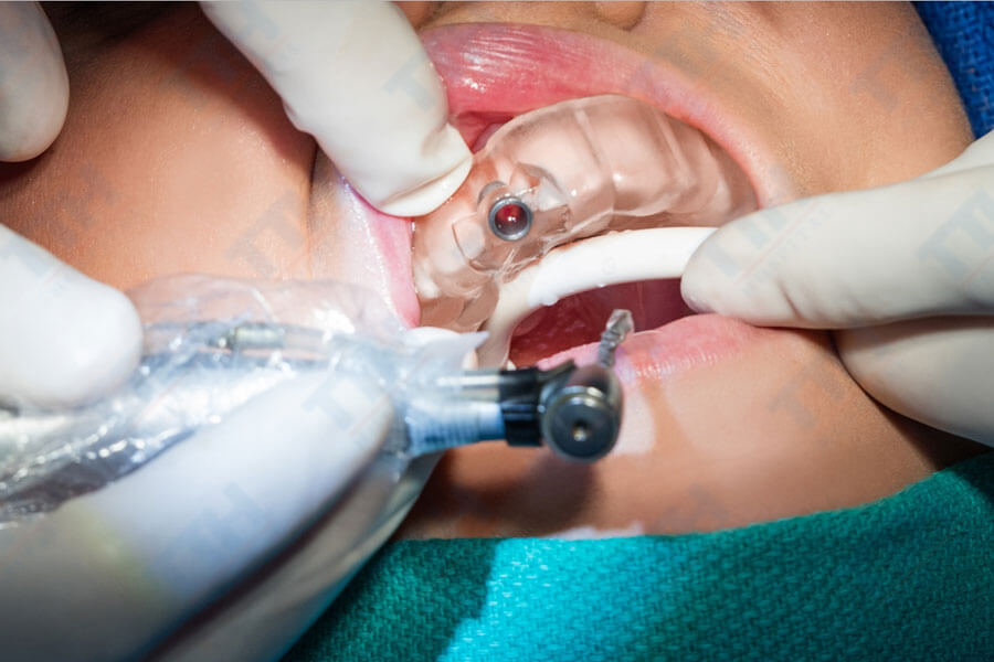 Giảm thiểu rủi ro trong quá trình phẫu thuật implant