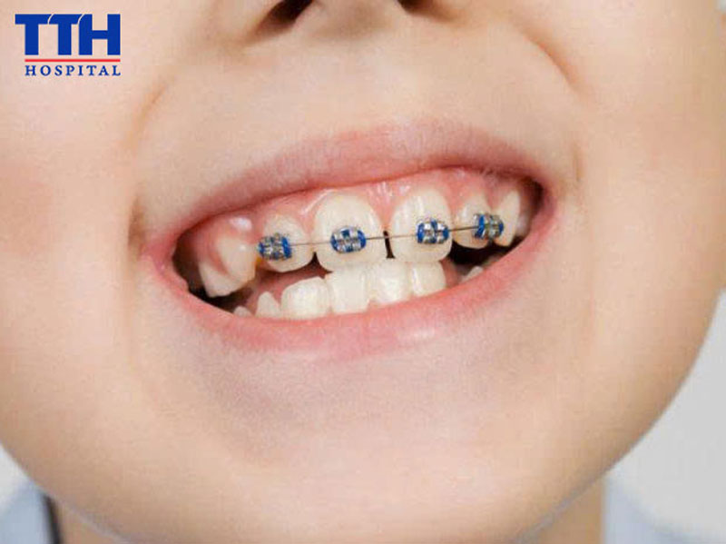 Can thiệp chỉnh nha sớm là gì?