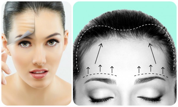 Căng da trán phù hợp với ai