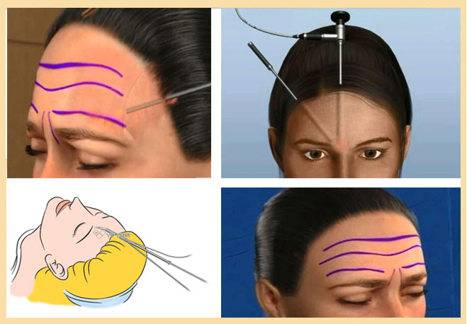 Hiệu quả mang lại sau khi căng da trán