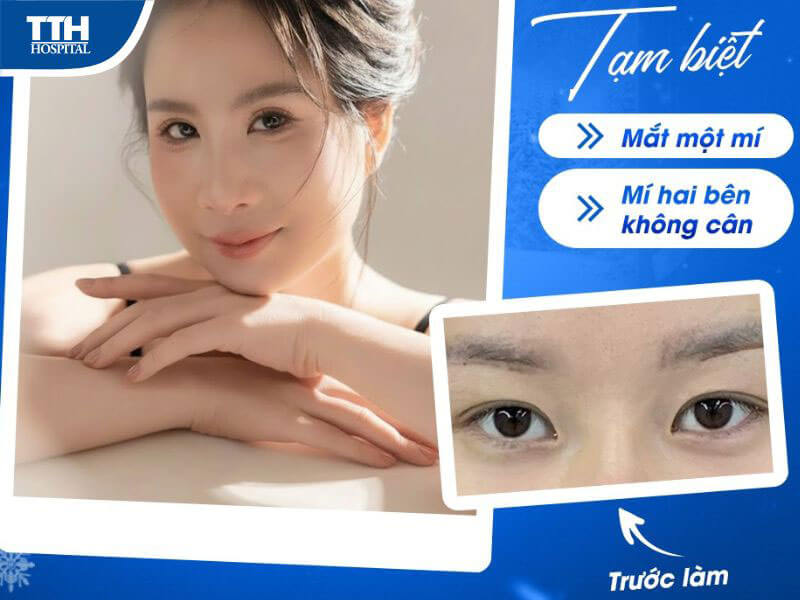 Cắt mí mắt an toàn tại Bệnh viện Thái Thượng Hoàng