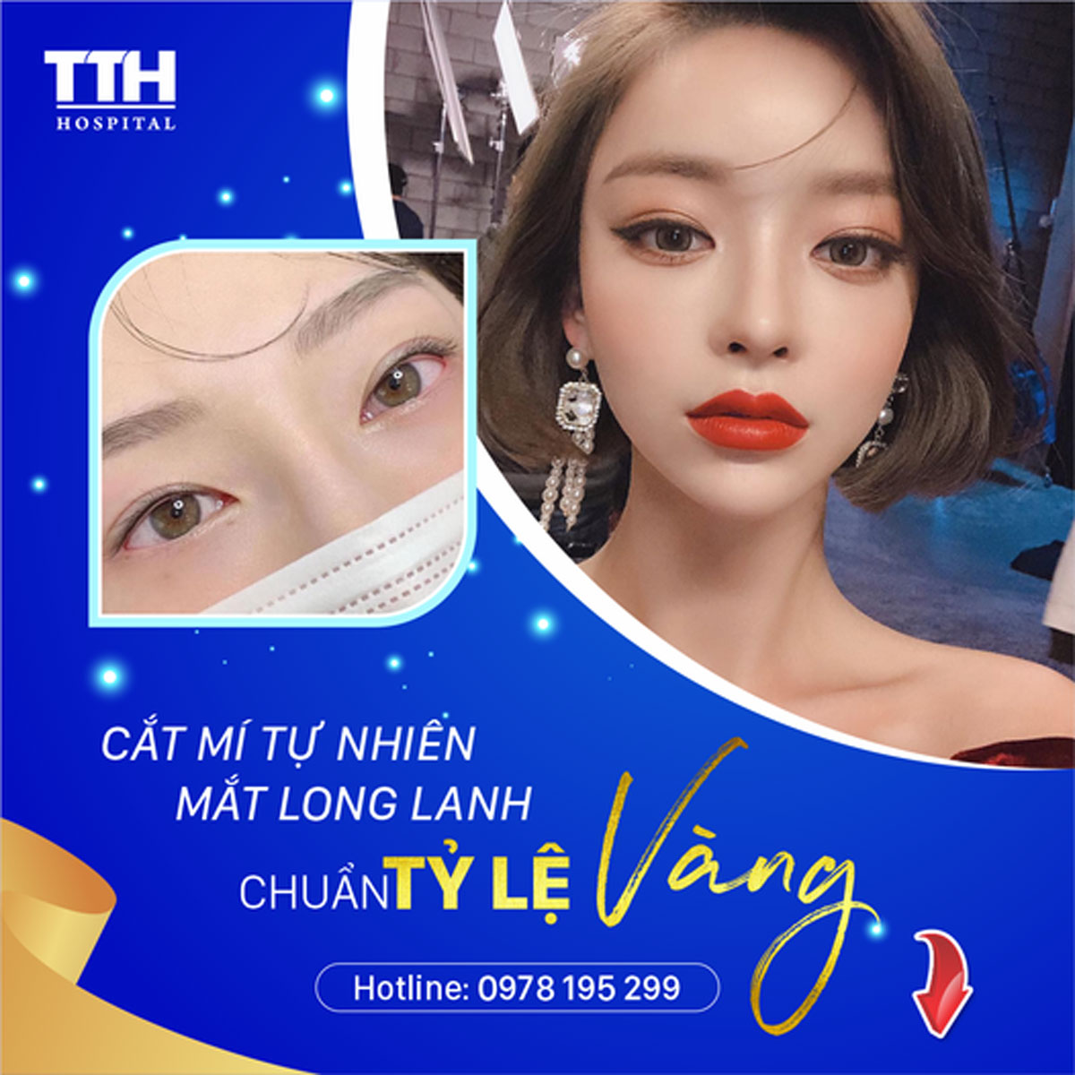 Cắt mí nâng cao vẻ đẹp