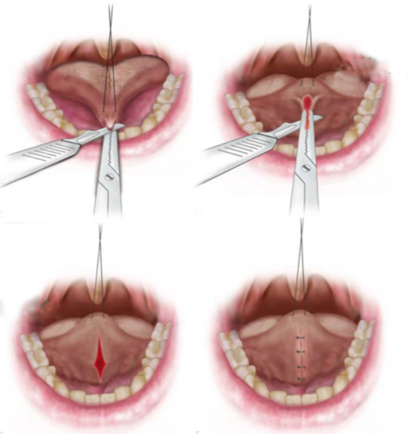 Phẫu thuật cắt thắng lưỡi tại Bệnh viện Răng hàm mặt và Phẫu thuật tạo hình thẩm mỹ Thái Thượng Hoàng