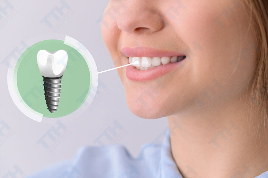 Câu hỏi thường gặp khi trồng răng Implant