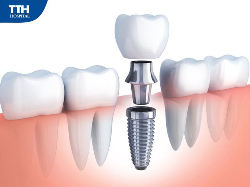 Cấu tạo răng Implant