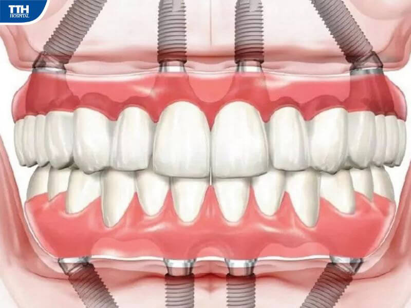 Cấy ghép implant toàn hàm áp dụng cho trường hợp nào?