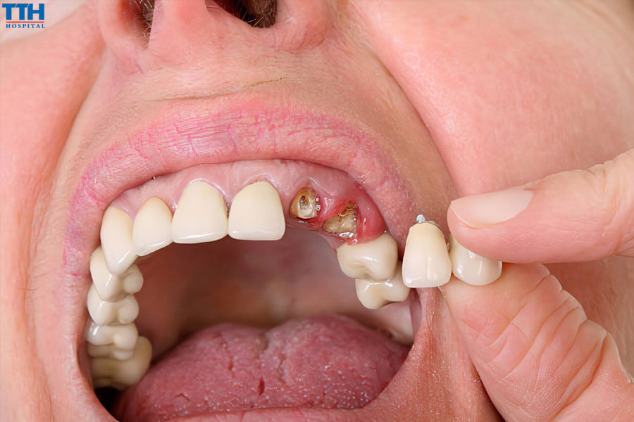Chọn implant dựa trên giá cả mà không quan tâm đến chất lượng và sự phù hợp.