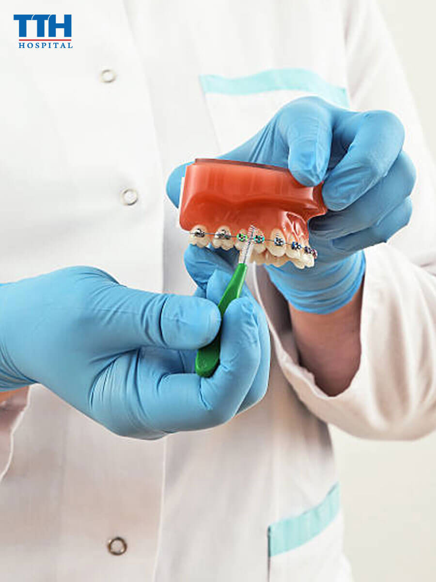 Chuẩn bị kiến thức chăm sóc răng miệng khi niềng