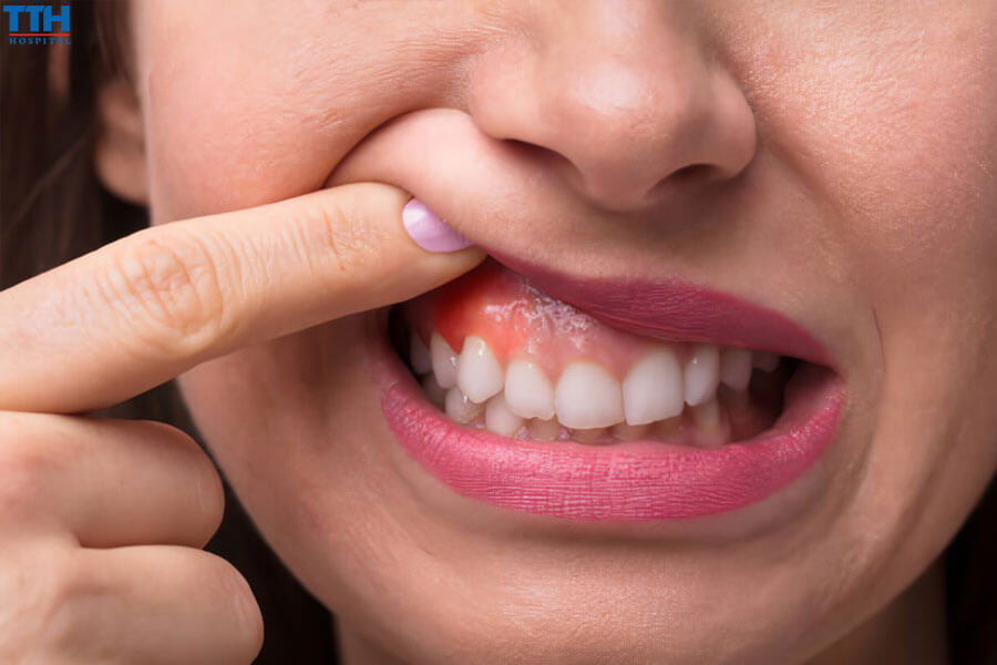 Có Nốt Sưng Nhỏ Trên Nướu