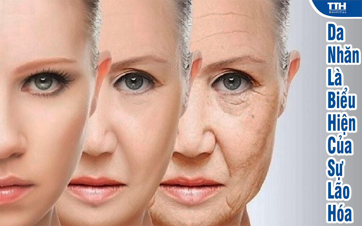 Da nhăn là biểu hiện của sự lão hóa