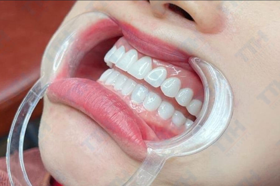 Tại sao nên chọn Orodent Gold Zirconia (A1)?