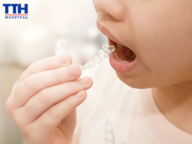 DẤU HIỆU NHẬN BIẾT TRẺ CẦN NIỀNG RĂNG