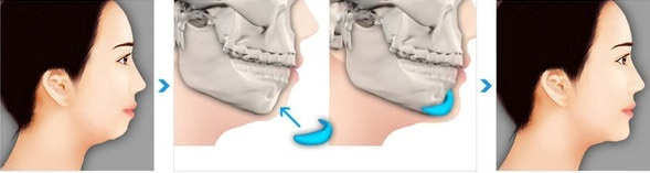Phẫu thuật độn cằm lẹm tại Bệnh viện Thái Thượng Hoàng