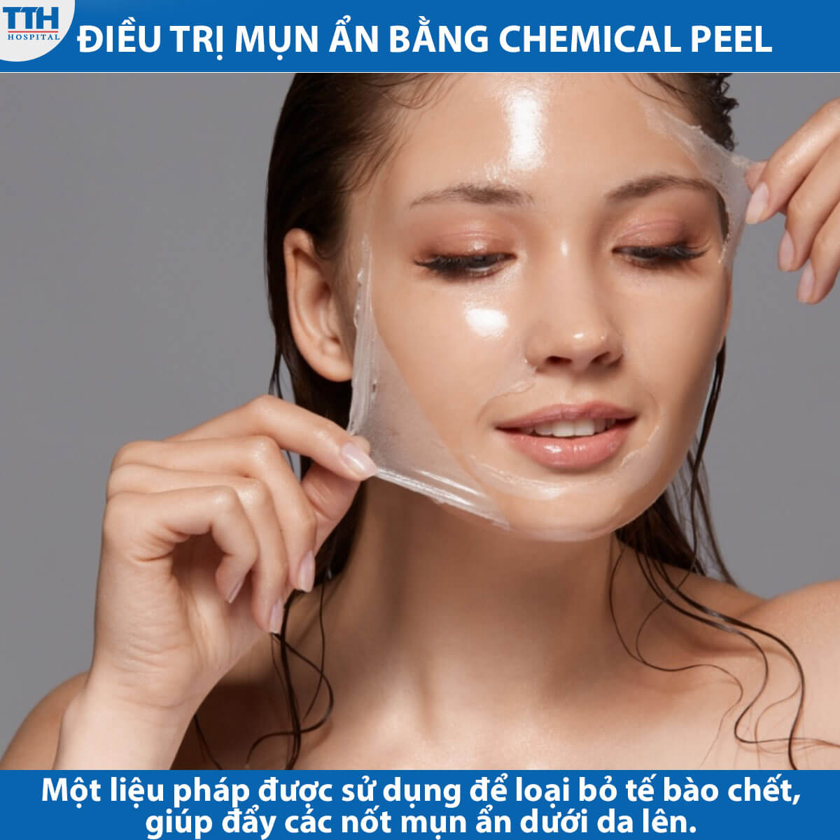 Điều trị mụn ẩn bằng công nghệ Chemical Peel