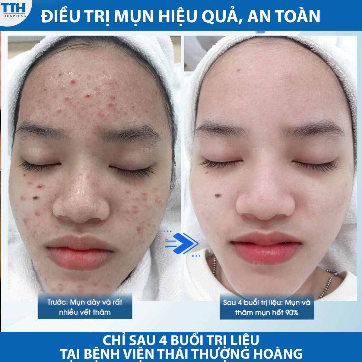 Điều trị mụn hiệu quả, an toàn tại bệnh viện Thái Thượng Hoàng