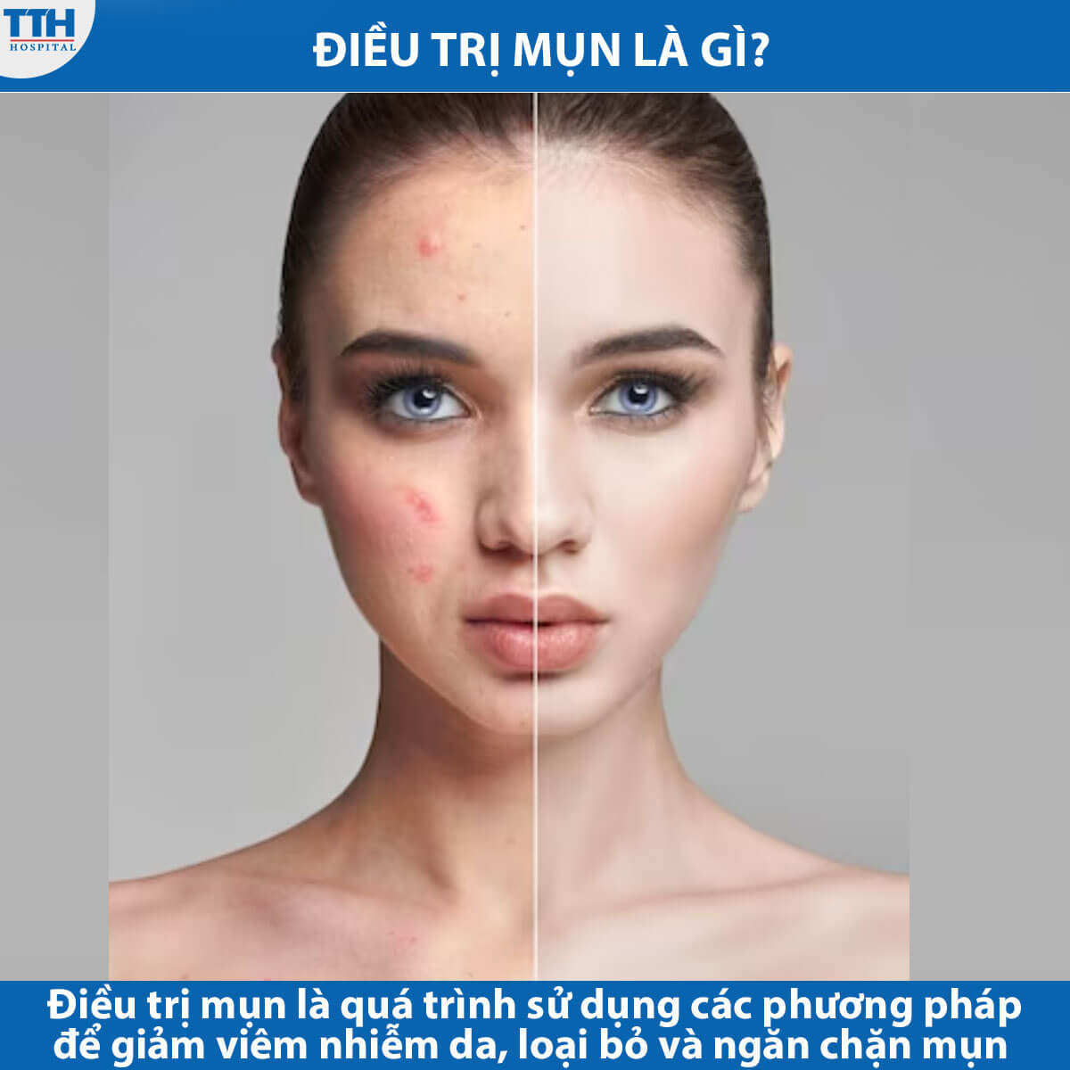 Điều trị mụn là gì