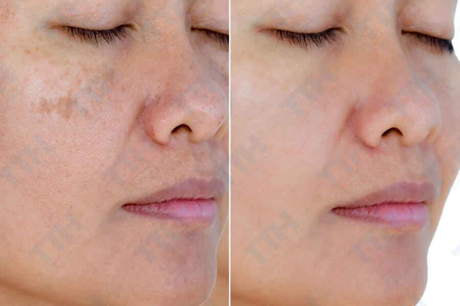 Điều trị sẹo và vết thâm