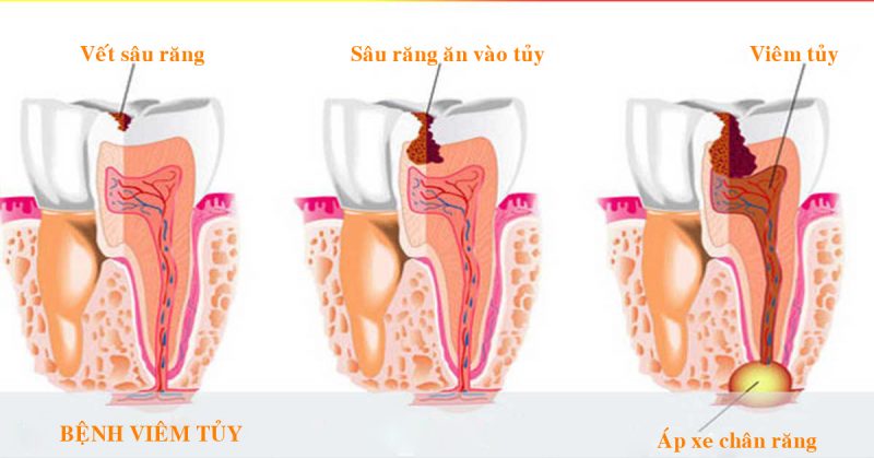 Nguyên nhân viêm tuỷ răng sữa