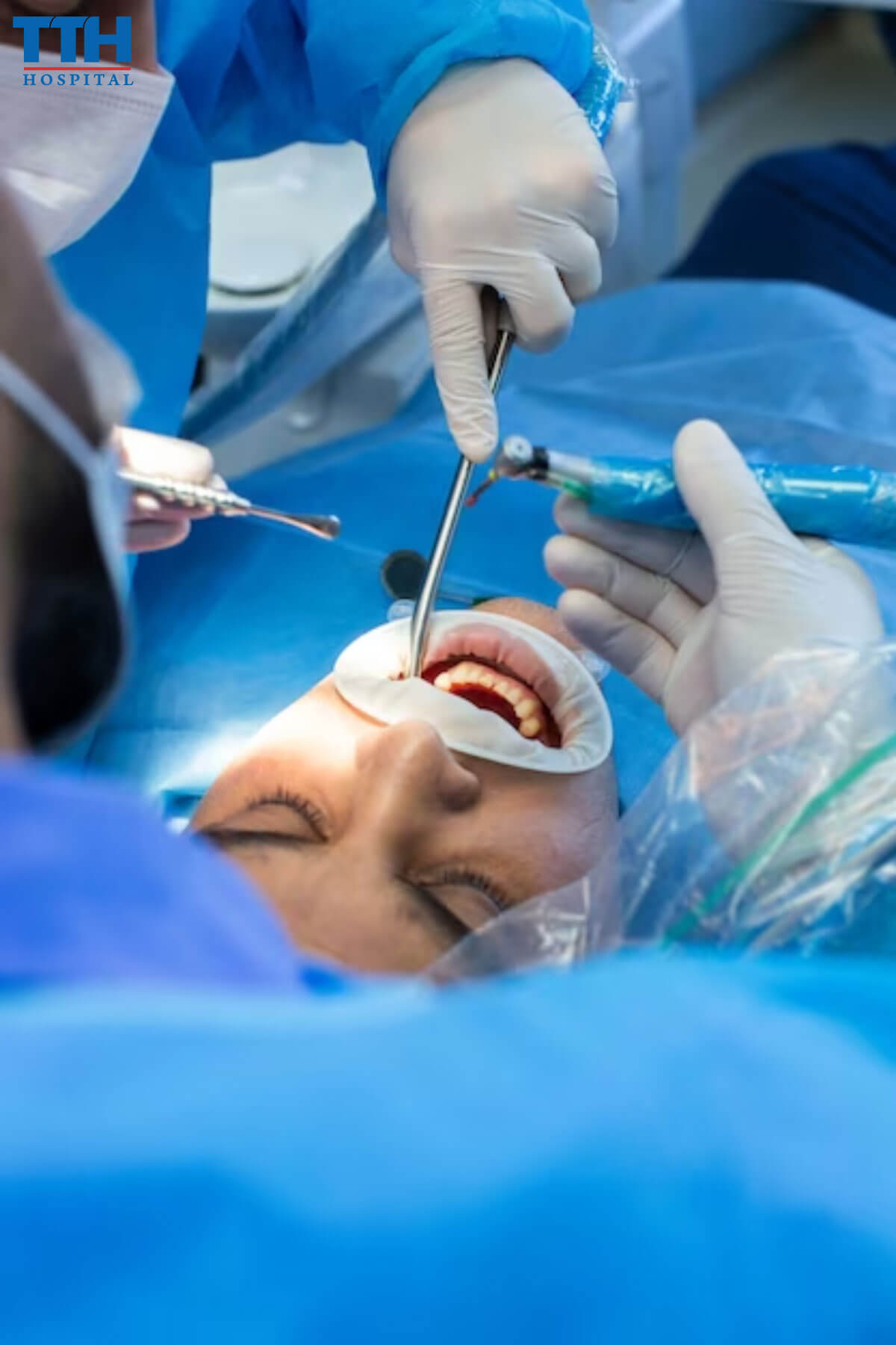Điều Trị Tủy tại Vinh, Nghệ An Là Gì?