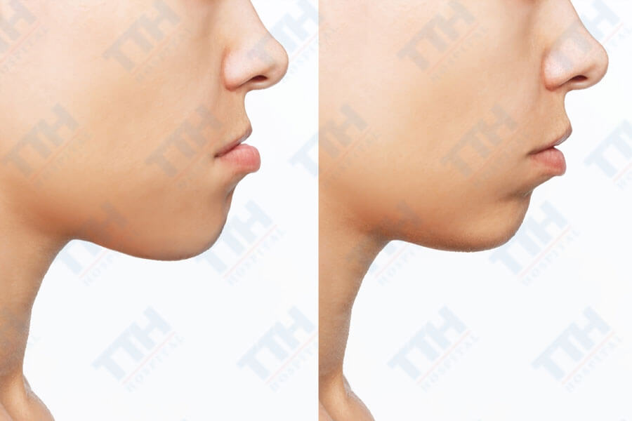 Độ tuổi vàng cho các loại phẫu thuật hàm mặt cụ thể