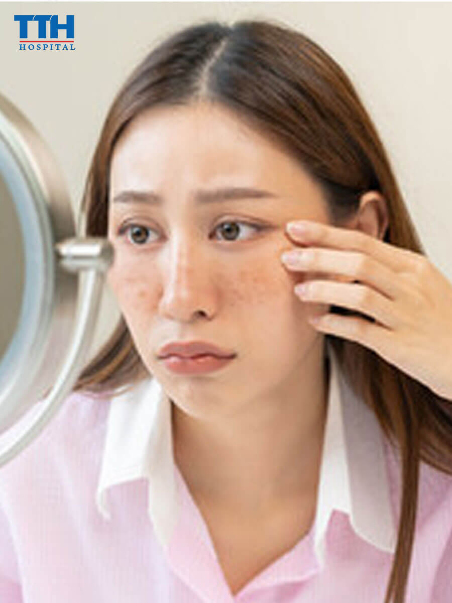 Đối tượng nguy cơ mắc nám da tại vinh nghệ an