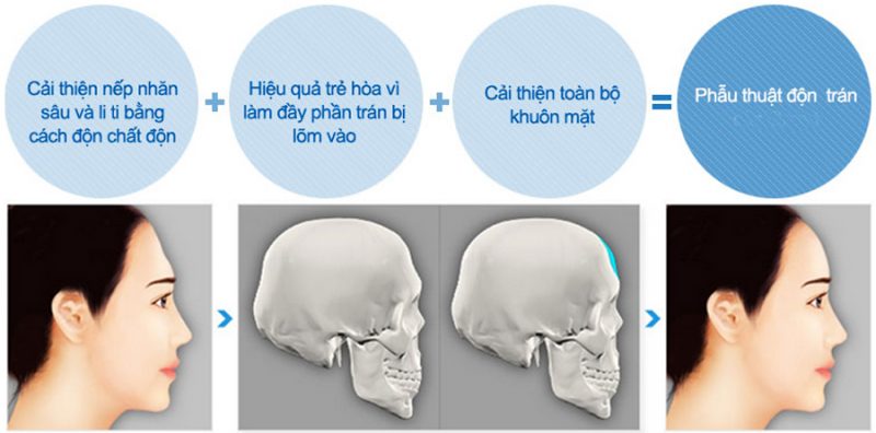 QUY TRÌNH THỰC HIỆN ĐỘN TRÁN