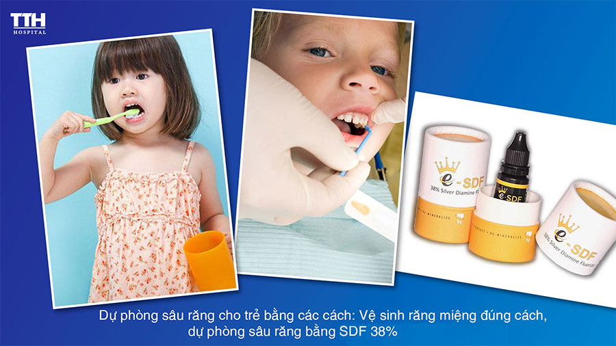 Dự phòng sâu răng cho trẻ