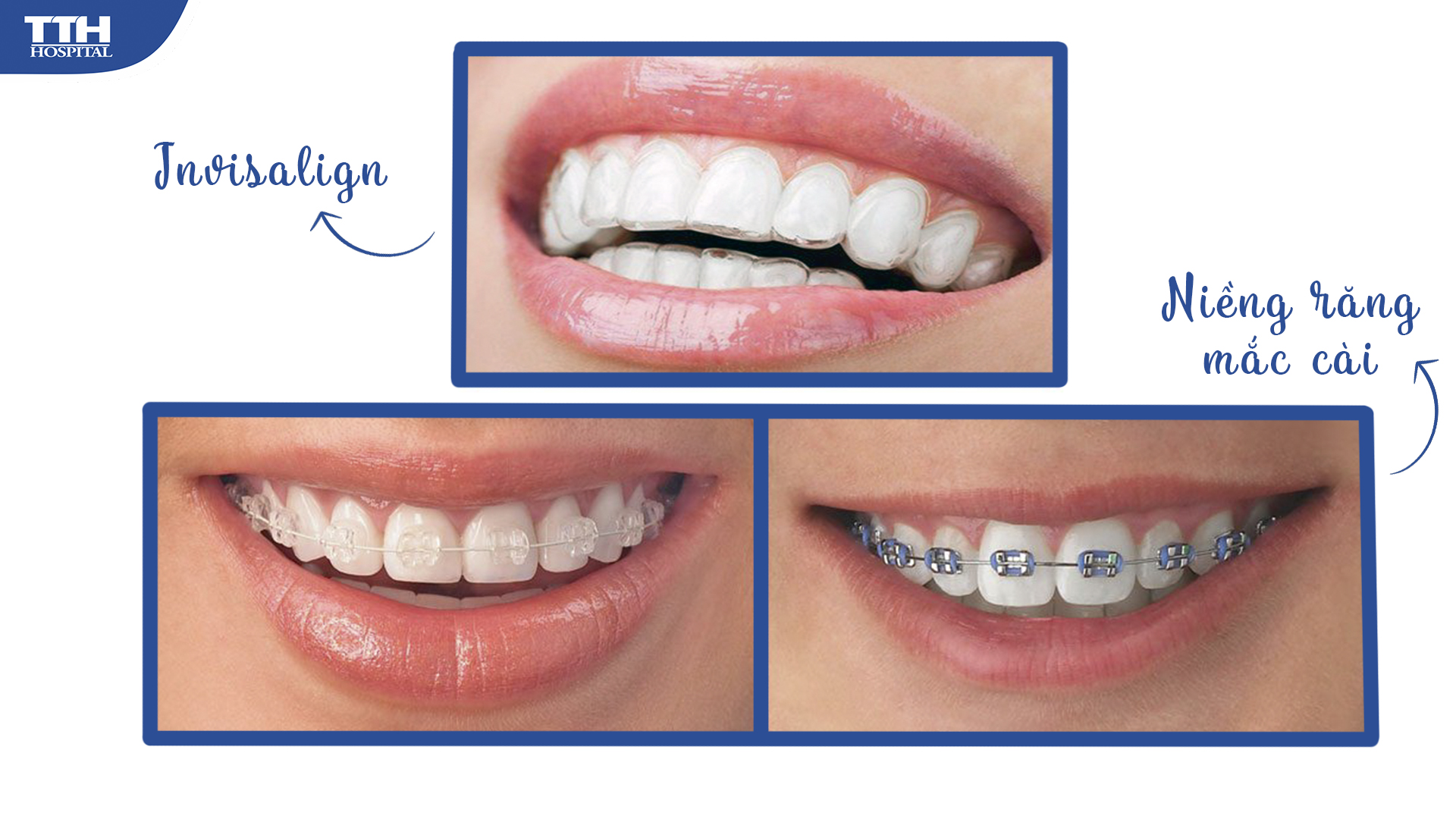 Niềng răng mắc cài sử dụng các giá đỡ kim loại trong khi Invisalign sử dụng khay niềng chế tác bằng SmartTrack