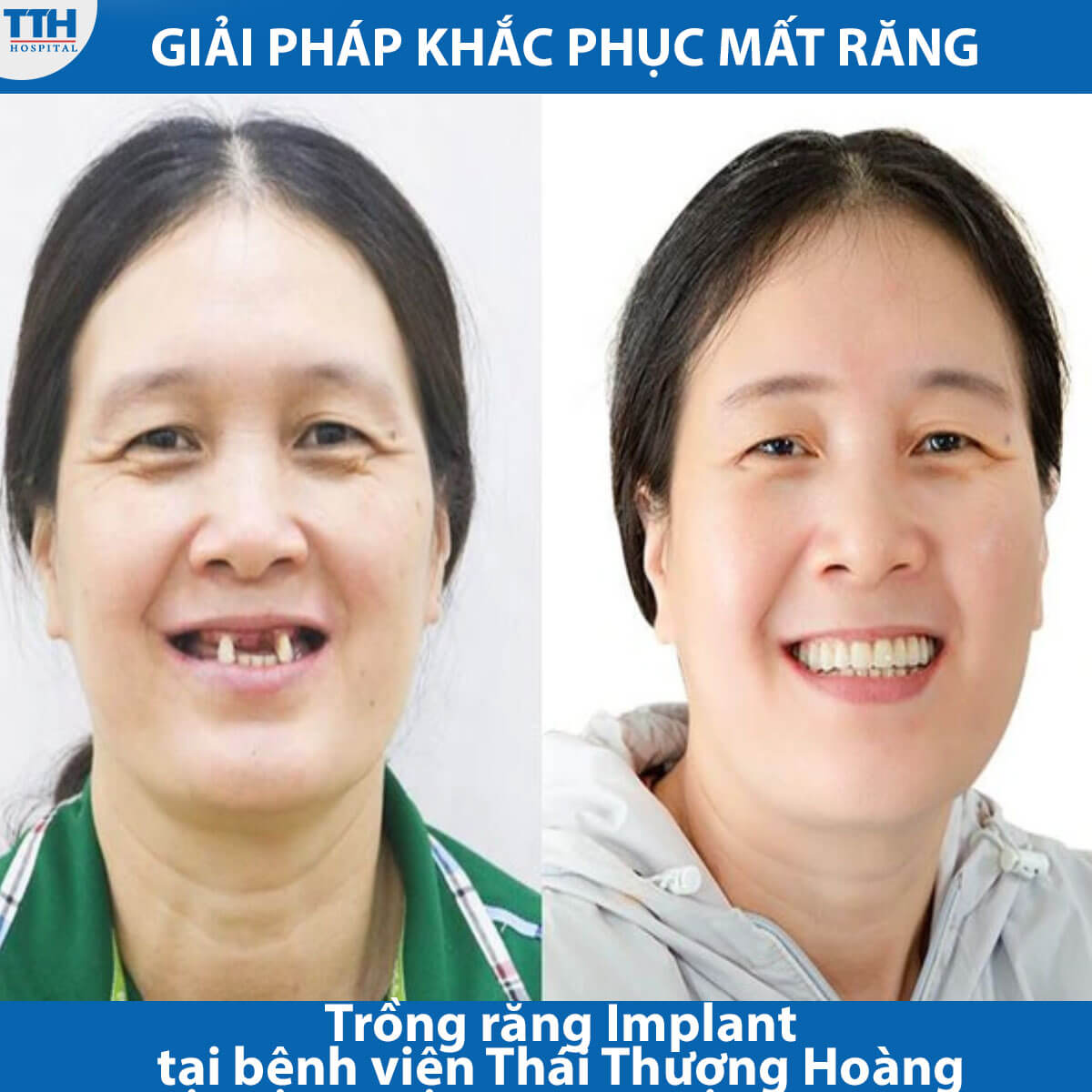 Trồng răng Implant tại bệnh viện Thái Thượng Hoàng