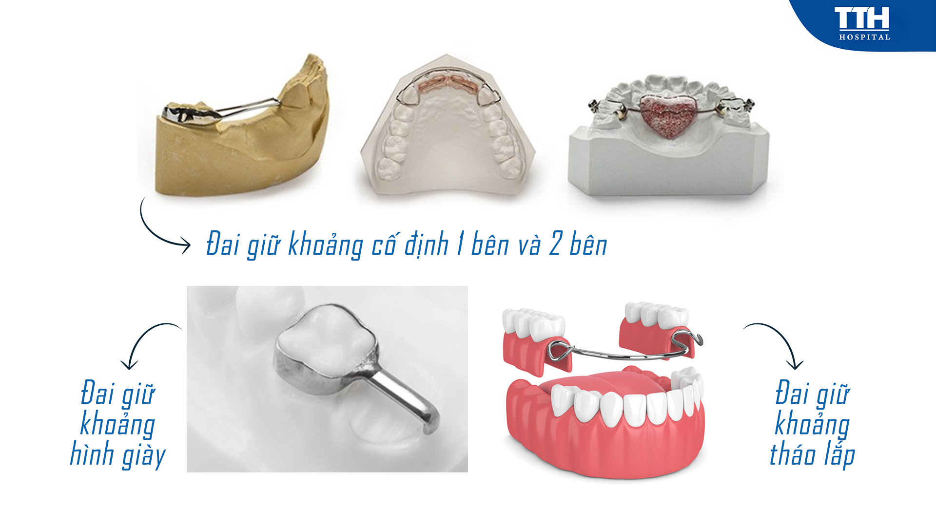 Các loại đai giữ khoảng được áp dùng tùy theo trường hợp mất răng của trẻ