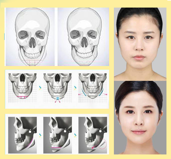 PHƯƠNG PHÁP THỰC HIỆN GỌT CẰM V- LINE