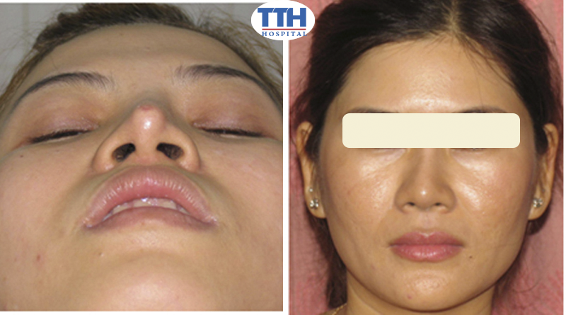 Sửa mũi hỏng sau nâng là phương pháp phẫu thuật mũi