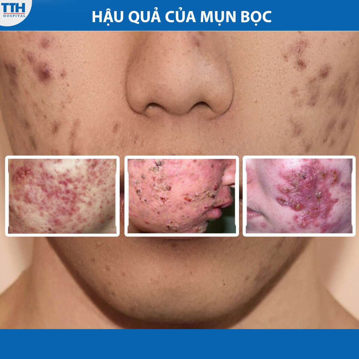 Hậu quả của mụn bọc