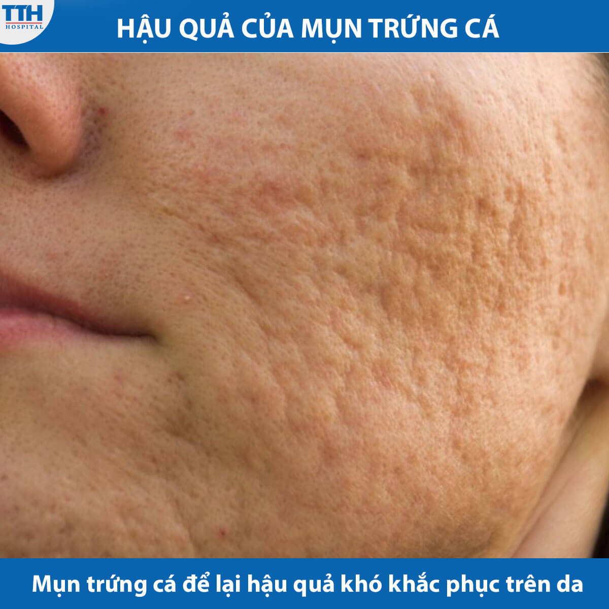 Hậu quả của mụn trứng cá