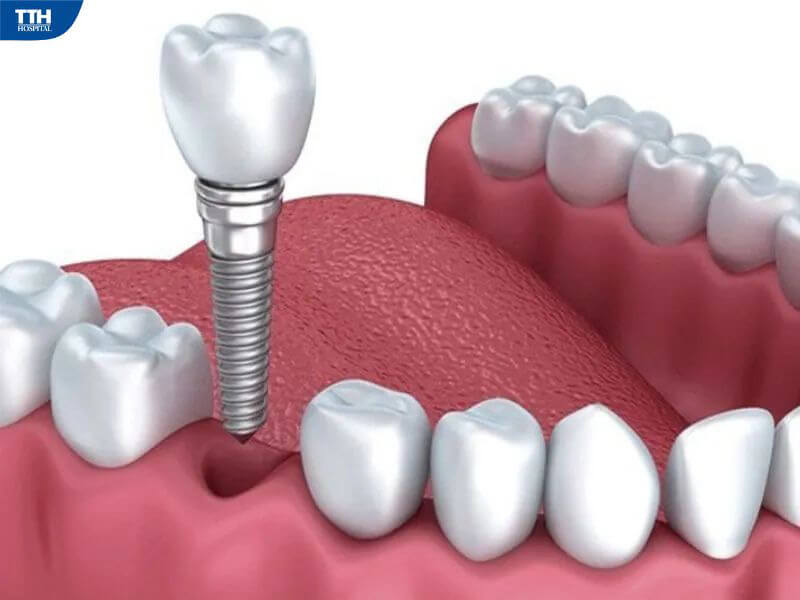 Hậu quả khi mất răng mà không trồng lại